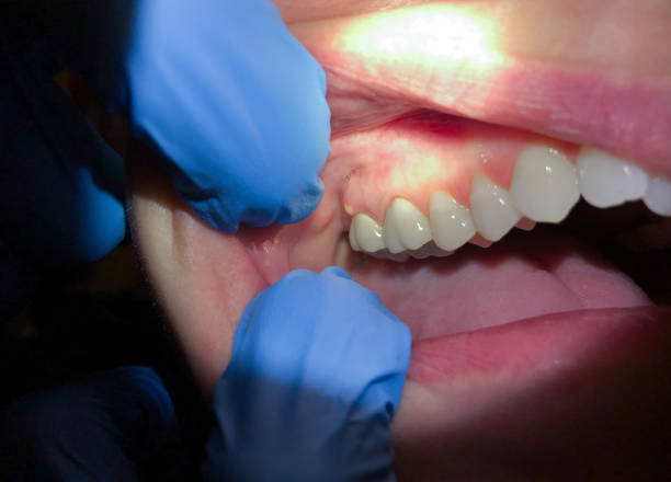Best Emergency Root Canal Treatment in Tuckahoe, NY